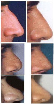 rhinoplsty (nose job) Clinic in Hyderabad